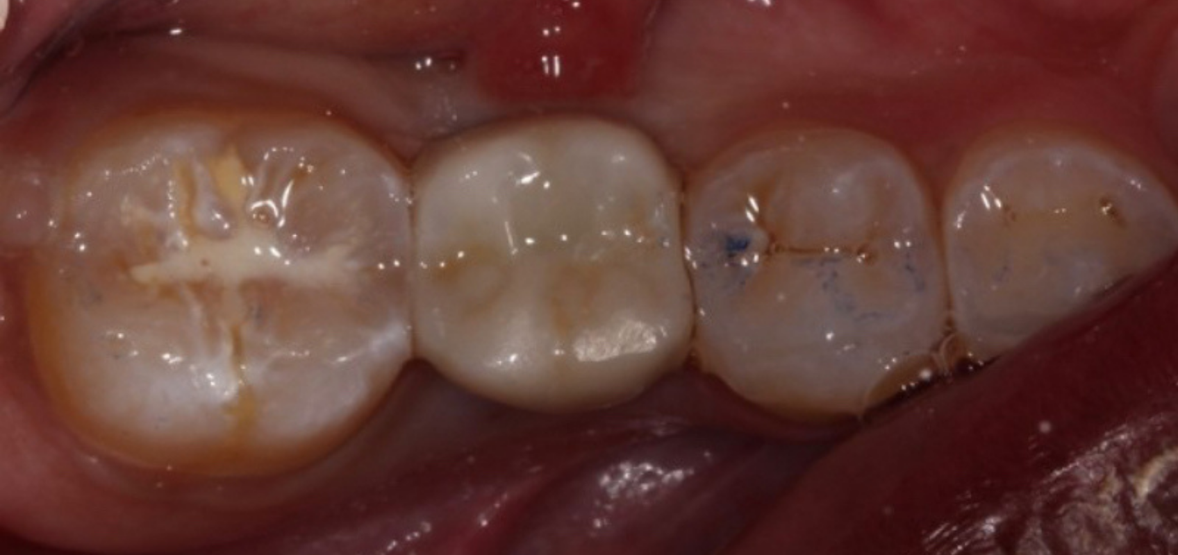 efrver Delivered screw retained implant crown with the screw access covered by composite for a finished occlusal surface