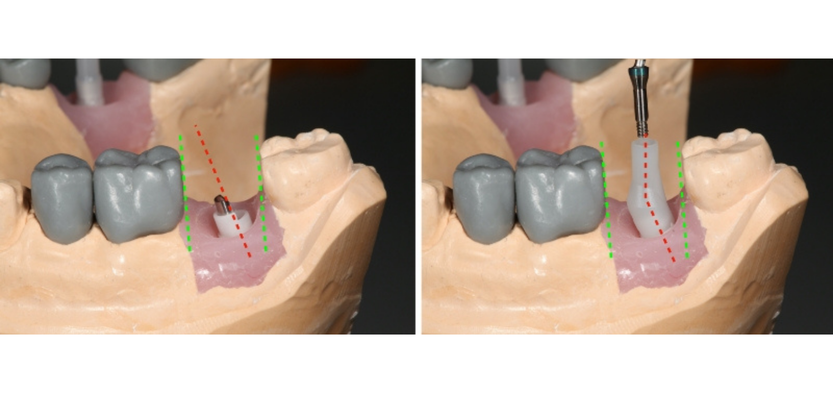 efrver Angled screw access channel on a screw retained implant crown demonstrating that changing the screw access angle does not change the restoration’s insertion path