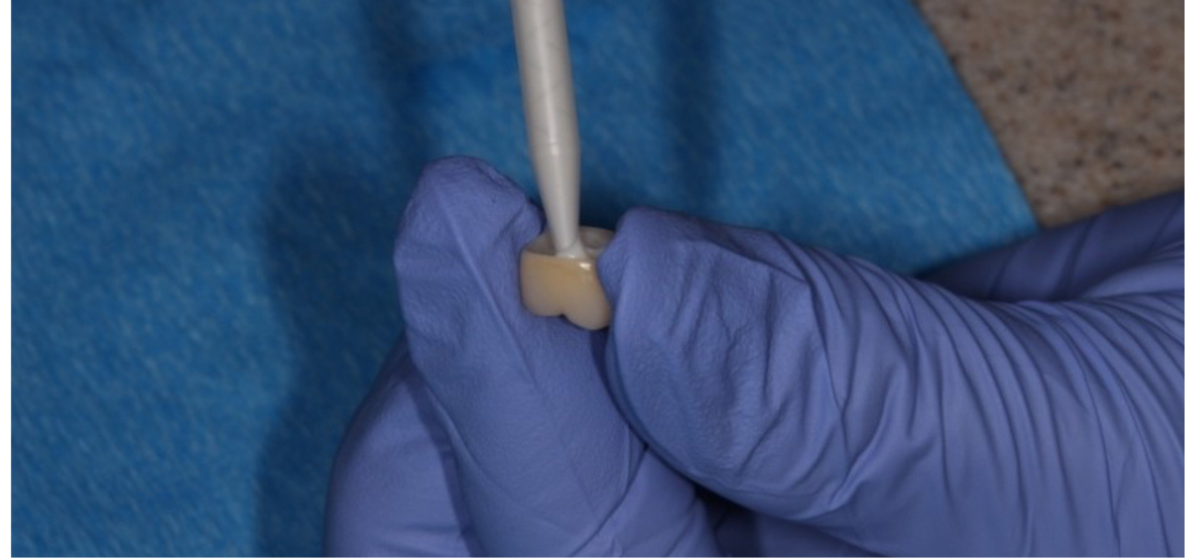 efrver Cement being placed extraorally into a screw retained implant crown before seating on the abutment