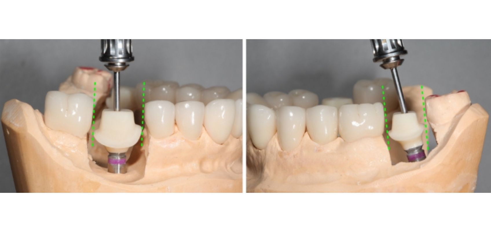 efrver Comparison showing how a cement-retained restoration can provide a different insertion path than a screw retained implant crown.