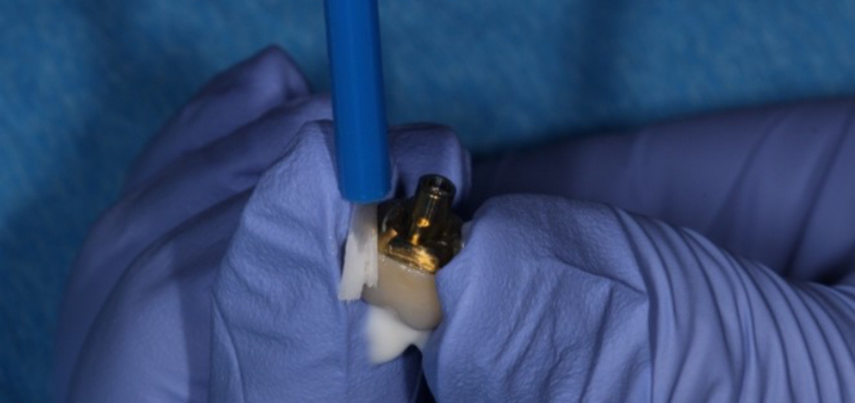efrver Excess cement being removed extraorally from a screw retained implant crown before intraoral delivery