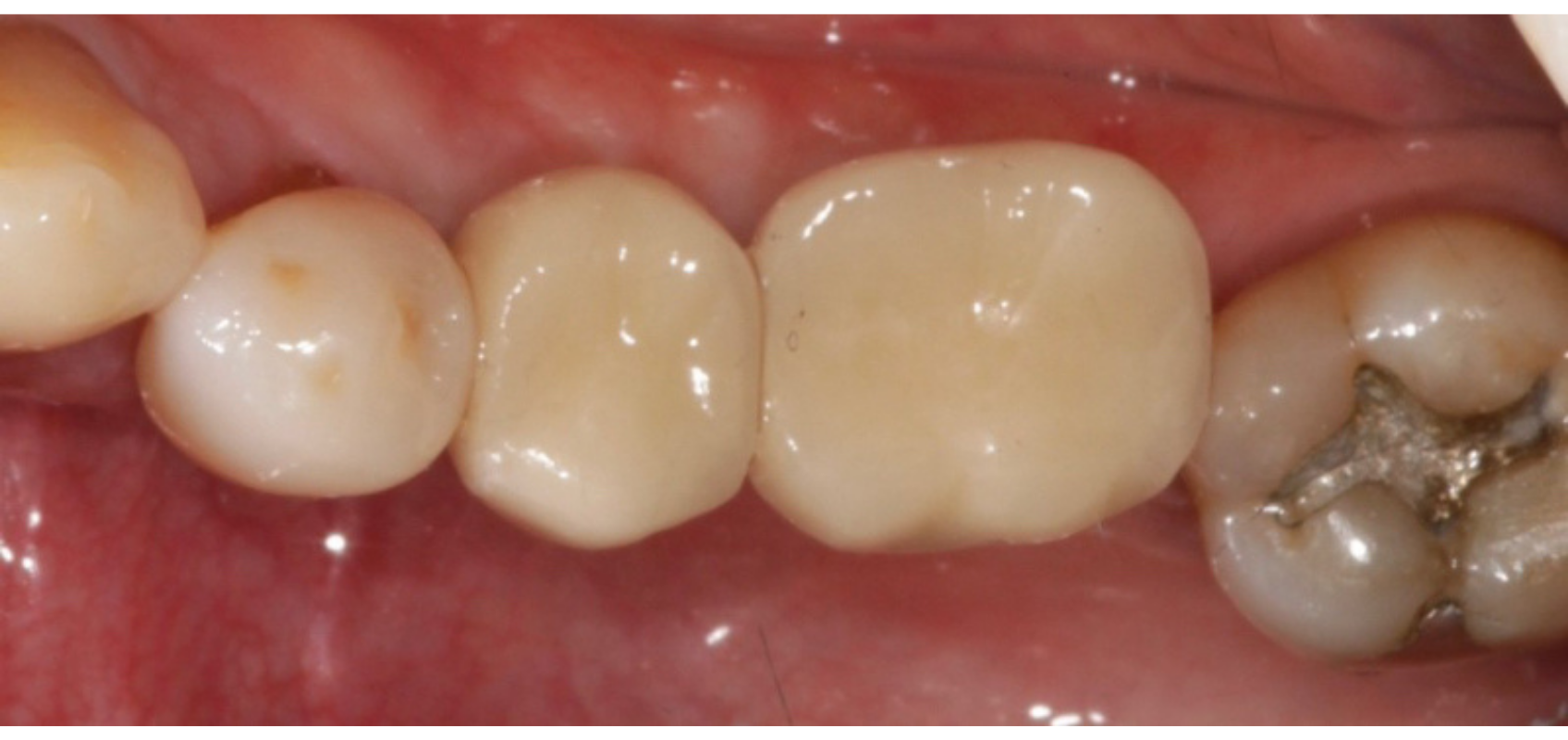efrver Cement-retained implant crowns showing posterior restorations without screw access holes