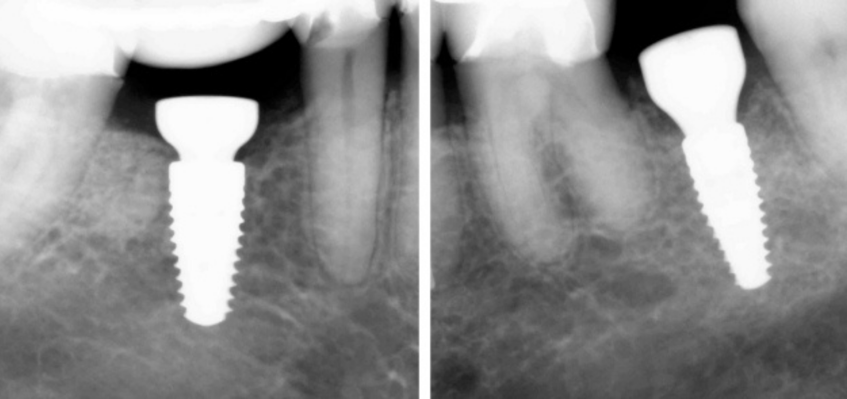 efrver Radiographs showing implant angulation and its influence on planning a screw retained implant crown.