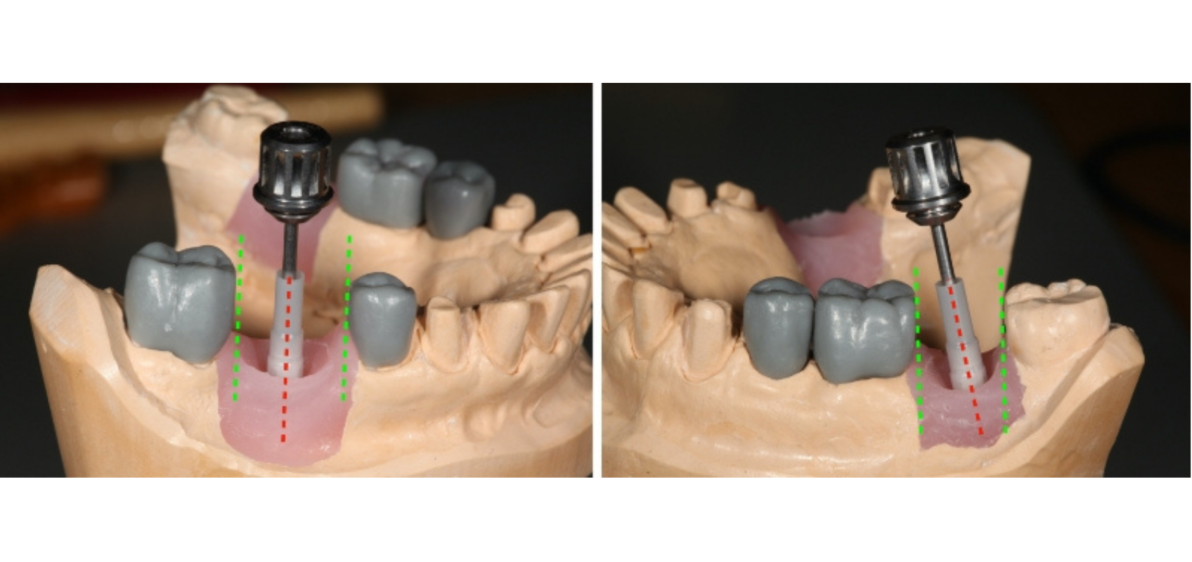 efrver Model demonstrating how implant angulation influences the insertion path of a screw retained implant crown.