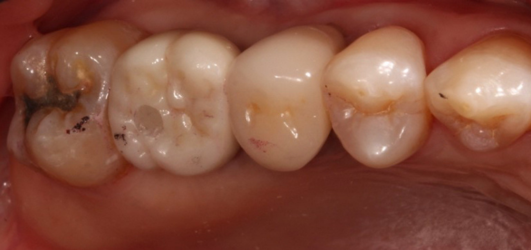 efrver Screw retained implant crown showing the occlusal screw access channel in a posterior restoration