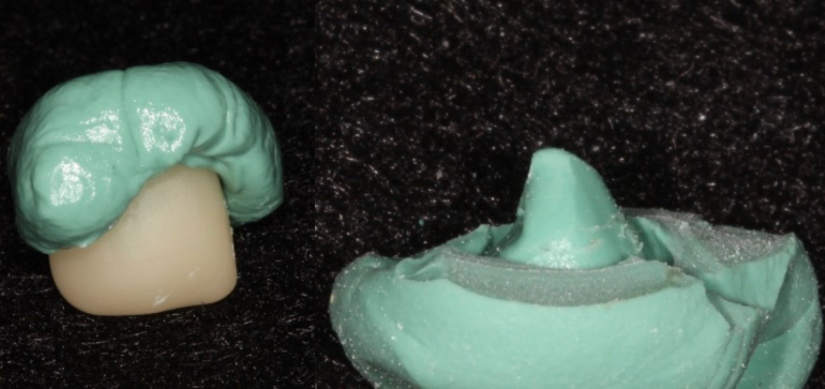 efrver Putty die fabricated from the intaglio surface of a screw retained implant crown to control excess cement during extraoral cementation.