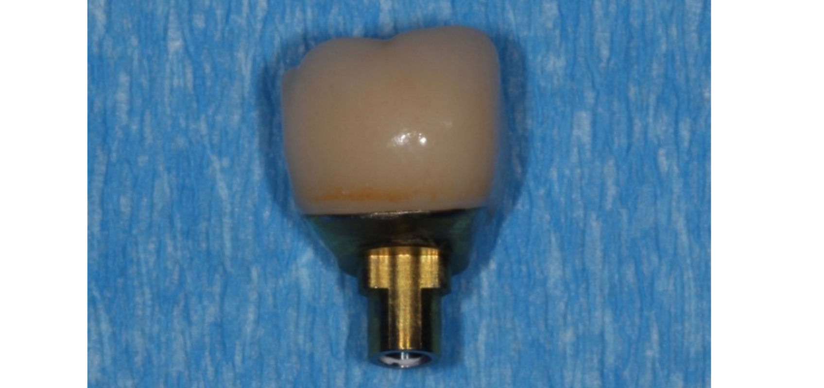 efrver Finished screwmentable screw retained implant crown with cement cleanup complete and ready for intraoral delivery