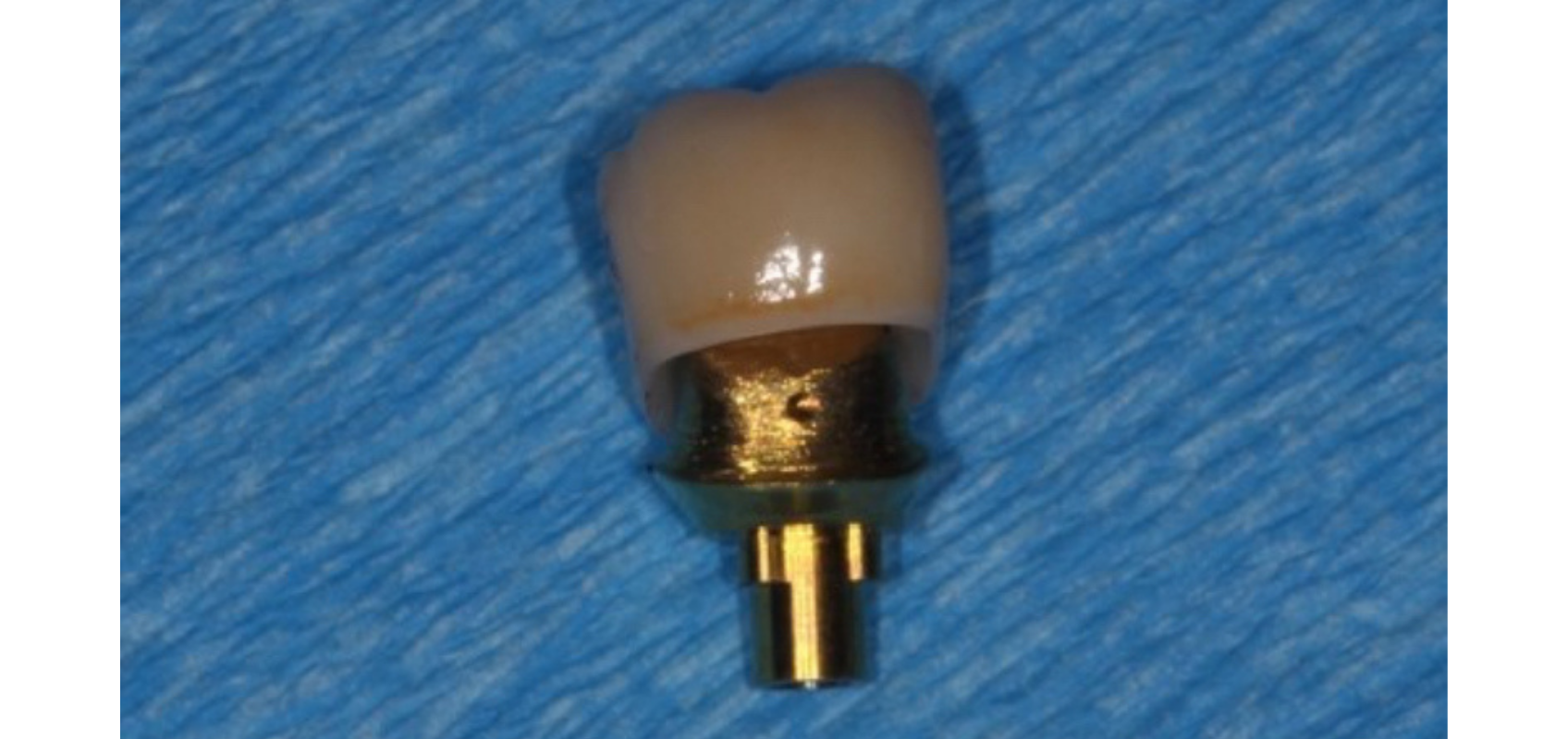 efrver Screw retained implant crown shown as a screwmentable restoration with gold abutment before cementation