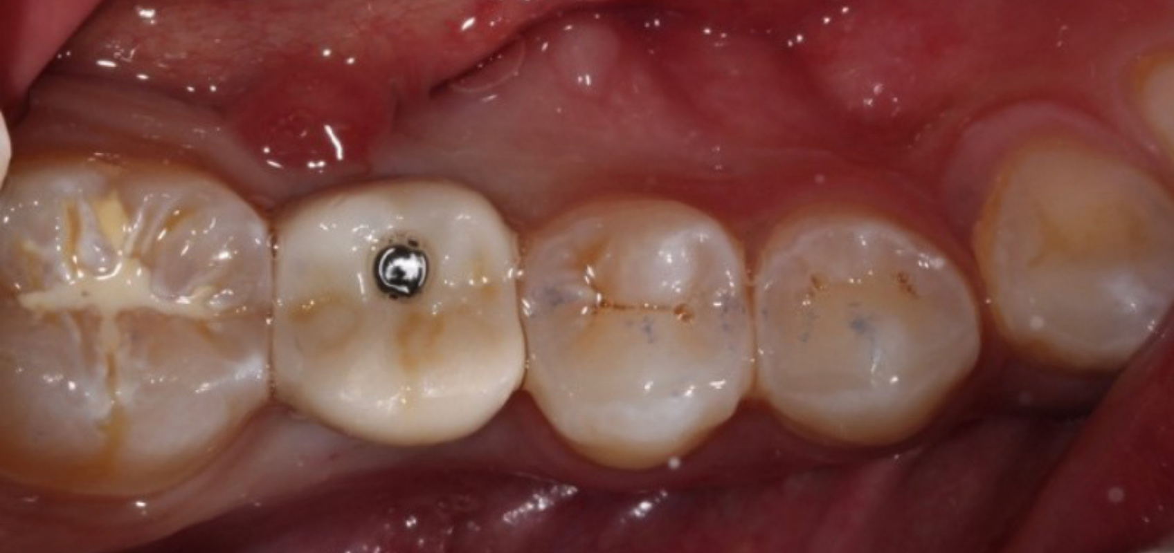 efrver Screwmentable screw retained implant crown seated intraorally in the posterior mandible with the screw access visible on the occlusal surface