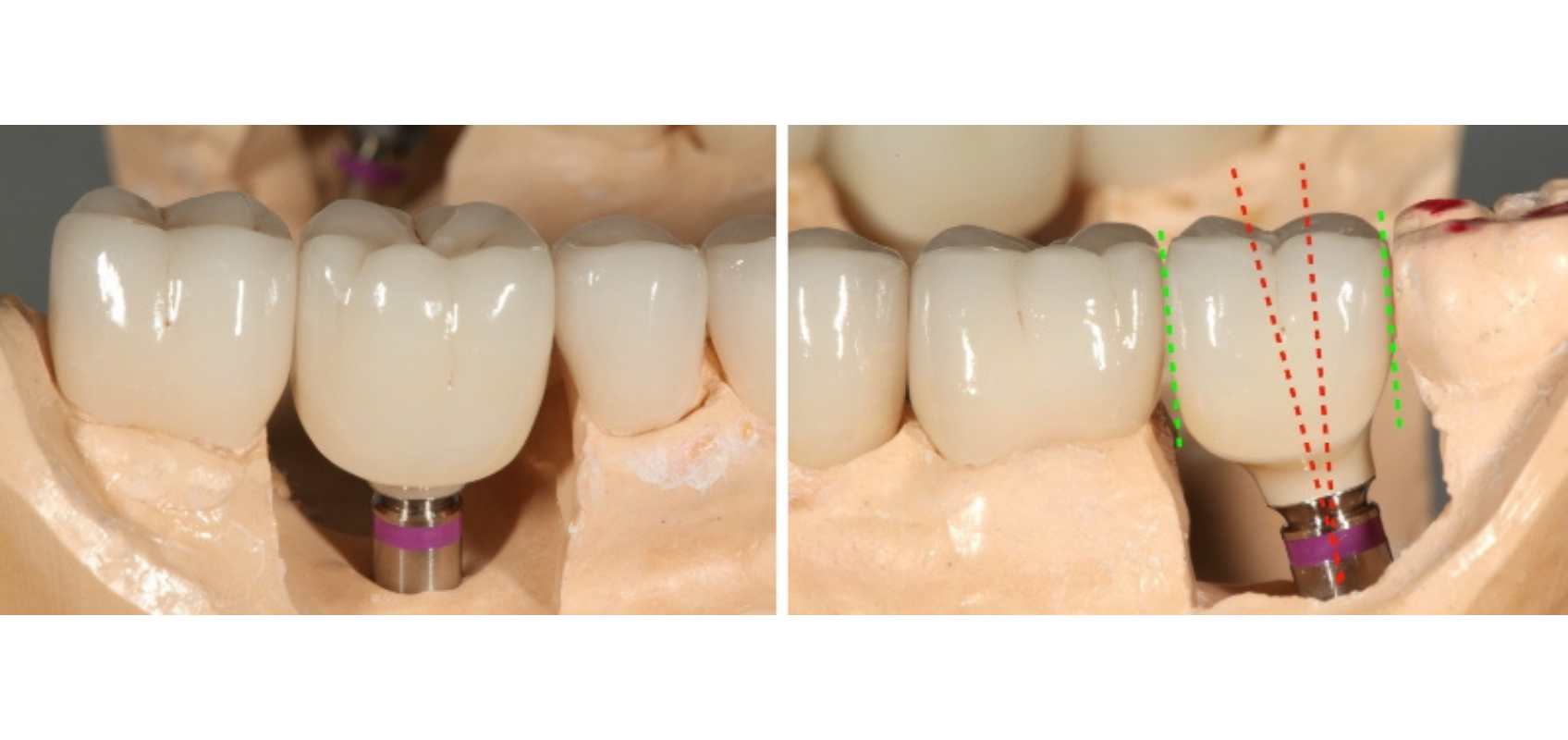 efrver Straight screw access channel illustrating approximately 10 degrees of restorative angulation for a screw retained implant crown.