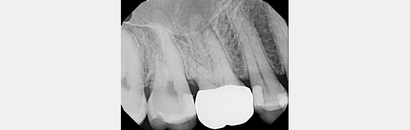 Identifying Pulpal Necrosis for Endodontic Treatment Mcintyre identifying pulpal necrosis 02