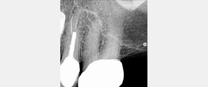 Identifying Pulpal Necrosis for Endodontic Treatment Mcintyre identifying pulpal necrosis 03