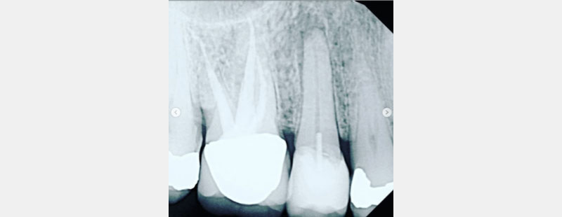 Identifying Pulpal Necrosis for Endodontic Treatment Mcintyre identifying pulpal necrosis 07