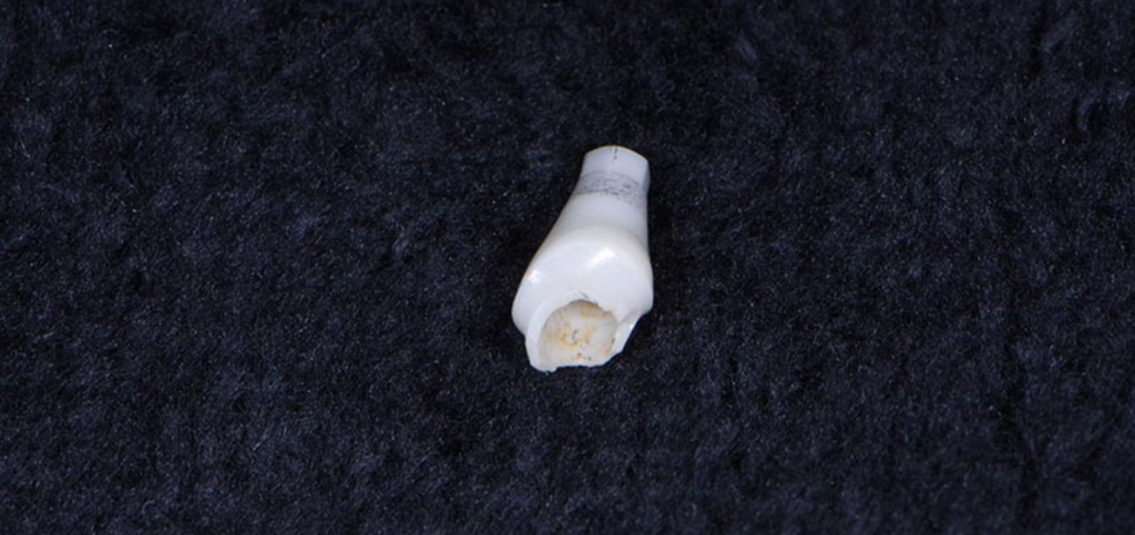 Essential Criteria for Choosing Zirconia Abutments Close-up of a fractured zirconia abutment showing the break at the implant connection.