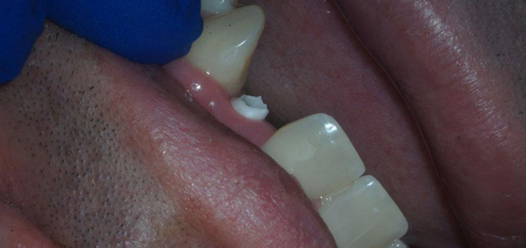 Essential Criteria for Choosing Zirconia Abutments Fractured zirconia abutment following placement of a new crown that increased forces on the restoration.