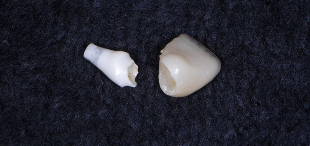 Essential Criteria for Choosing Zirconia Abutments Fractured zirconia abutment and crown after increased forces caused the implant restoration to fail.