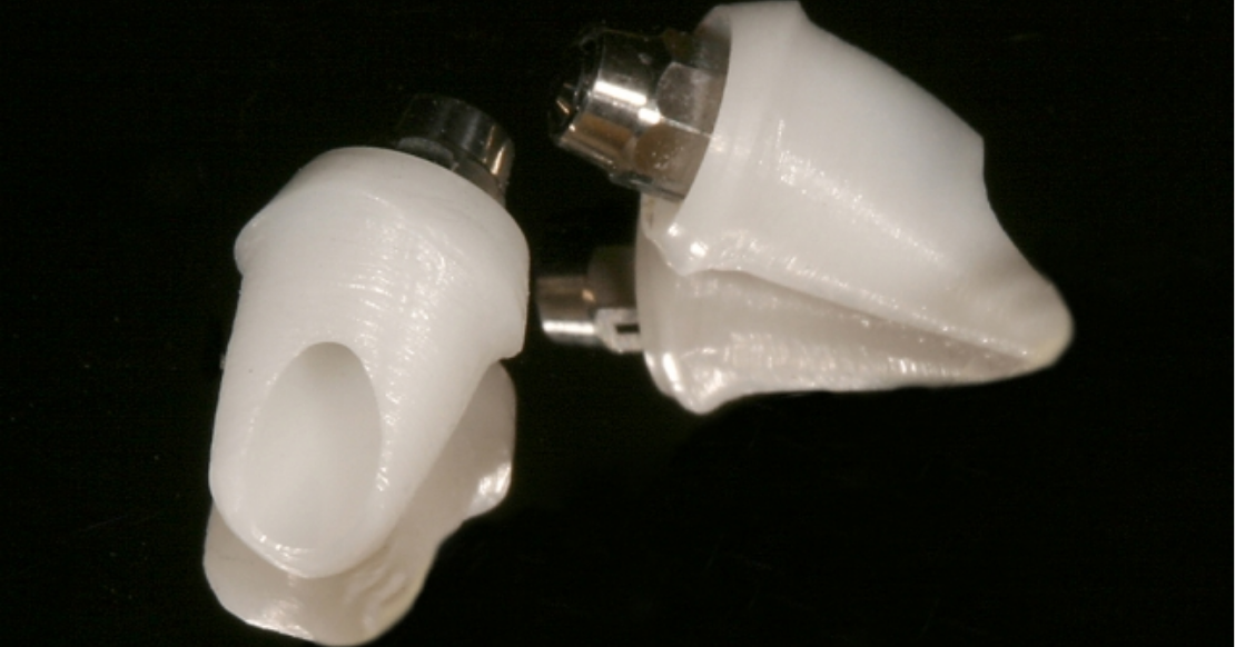 Essential Criteria for Choosing Zirconia Abutments Custom zirconia abutments with metal inserts that create a metal-to-metal connection between the abutment and implant.