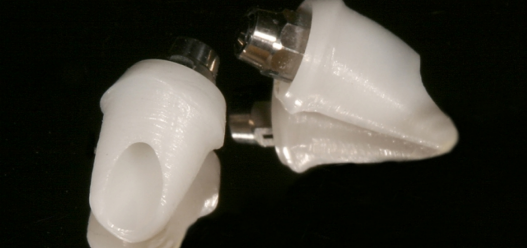 Essential Criteria for Choosing Zirconia Abutments Custom zirconia abutments with metal inserts that create a metal-to-metal connection between the abutment and implant.