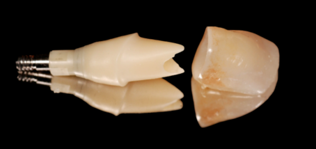 Essential Criteria for Choosing Zirconia Abutments One-piece custom zirconia abutment and crown showing an all-zirconia design with no metal reinforcement at the implant connection.