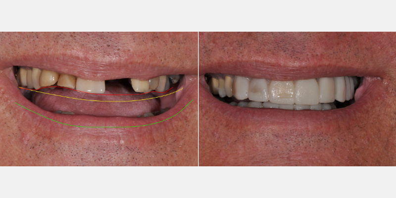 The ‘Trial Smile’ Overlay Template Bonk trial smile overlay 01