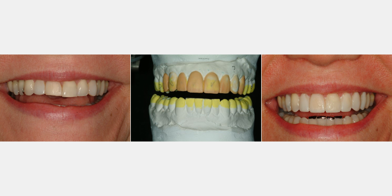 The ‘Trial Smile’ Overlay Template Bonk trial smile overlay 02 1