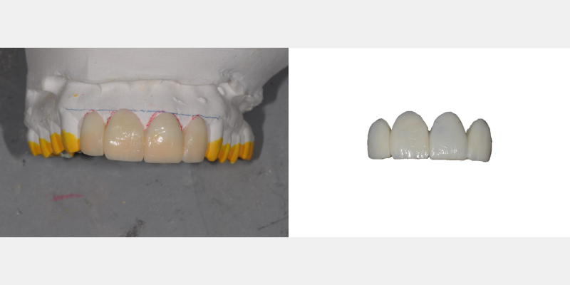 The ‘Trial Smile’ Overlay Template Bonk trial smile overlay 03 1