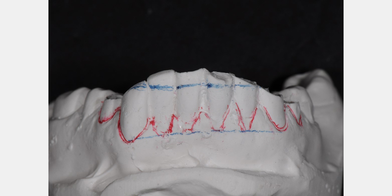 The ‘Trial Smile’ Overlay Template Bonk trial smile overlay 06