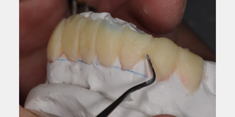 The ‘Trial Smile’ Overlay Template Bonk trial smile overlay 07