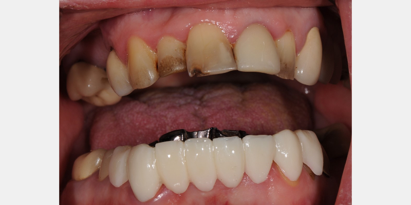 The ‘Trial Smile’ Overlay Template Bonk trial smile overlay 09