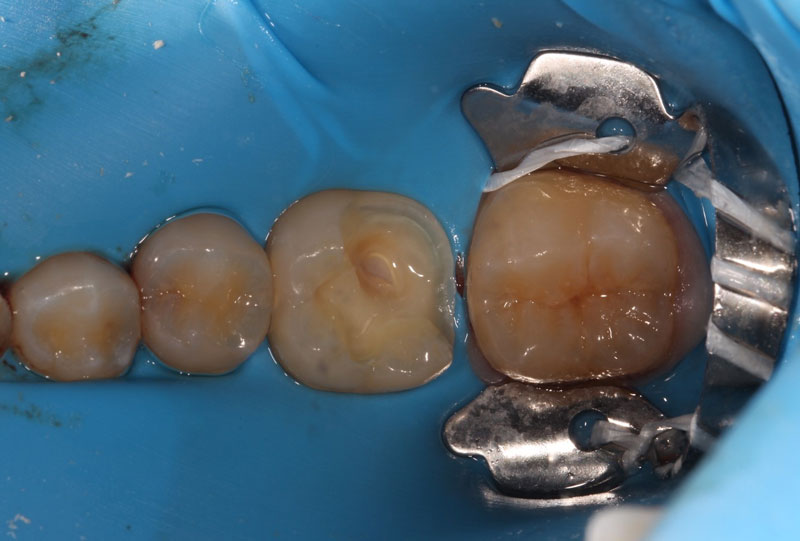 Pulp Capping: Can We and Should We? Janiga pulp capping should we 02