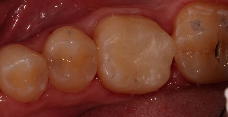 Pulp Capping: Can We and Should We? Janiga pulp capping should we 04