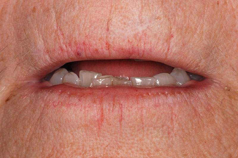 How to Phase Treatment Kinzer how to phase treatment 04 1