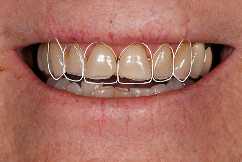 How to Phase Treatment Kinzer how to phase treatment 05 1