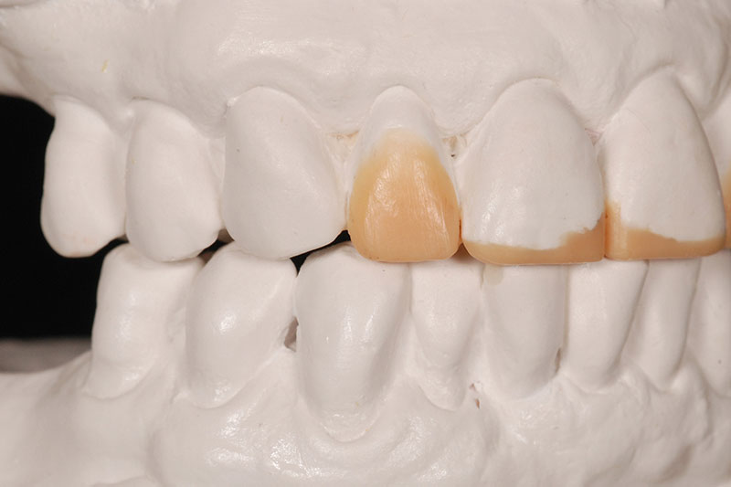 How to Phase Treatment Kinzer how to phase treatment 08