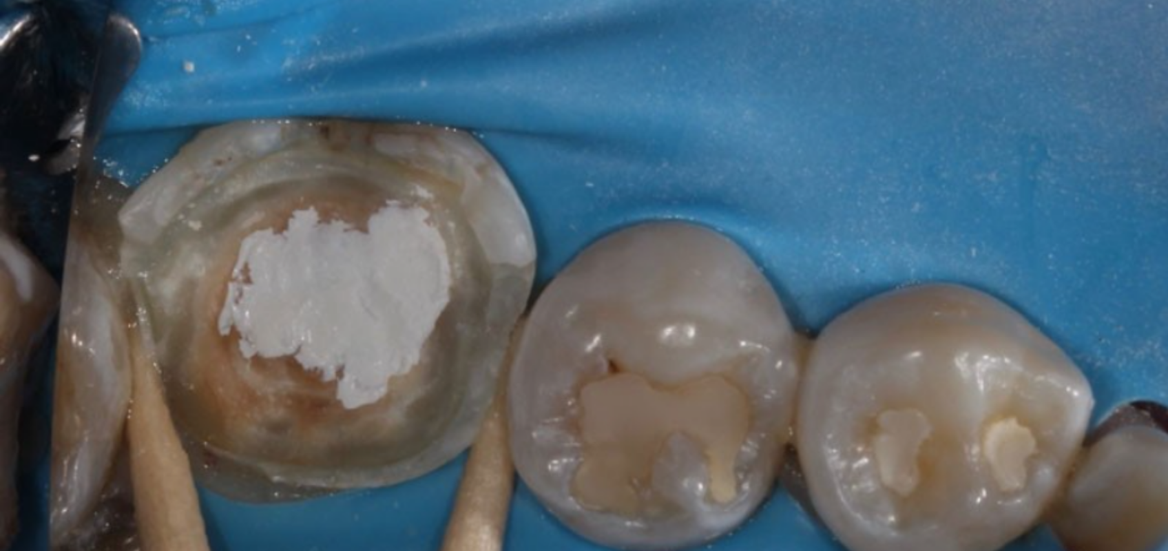 efrver Placement of bioceramic material during direct pulp capping on tooth #19 to protect exposed pulp tissue and promote healing.