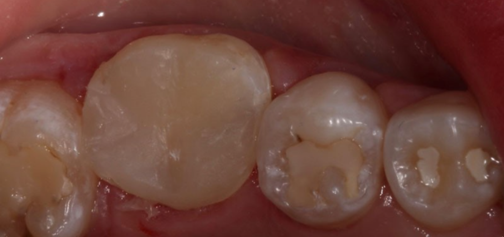 efrver Completed composite restoration following direct pulp capping treatment on tooth #19.