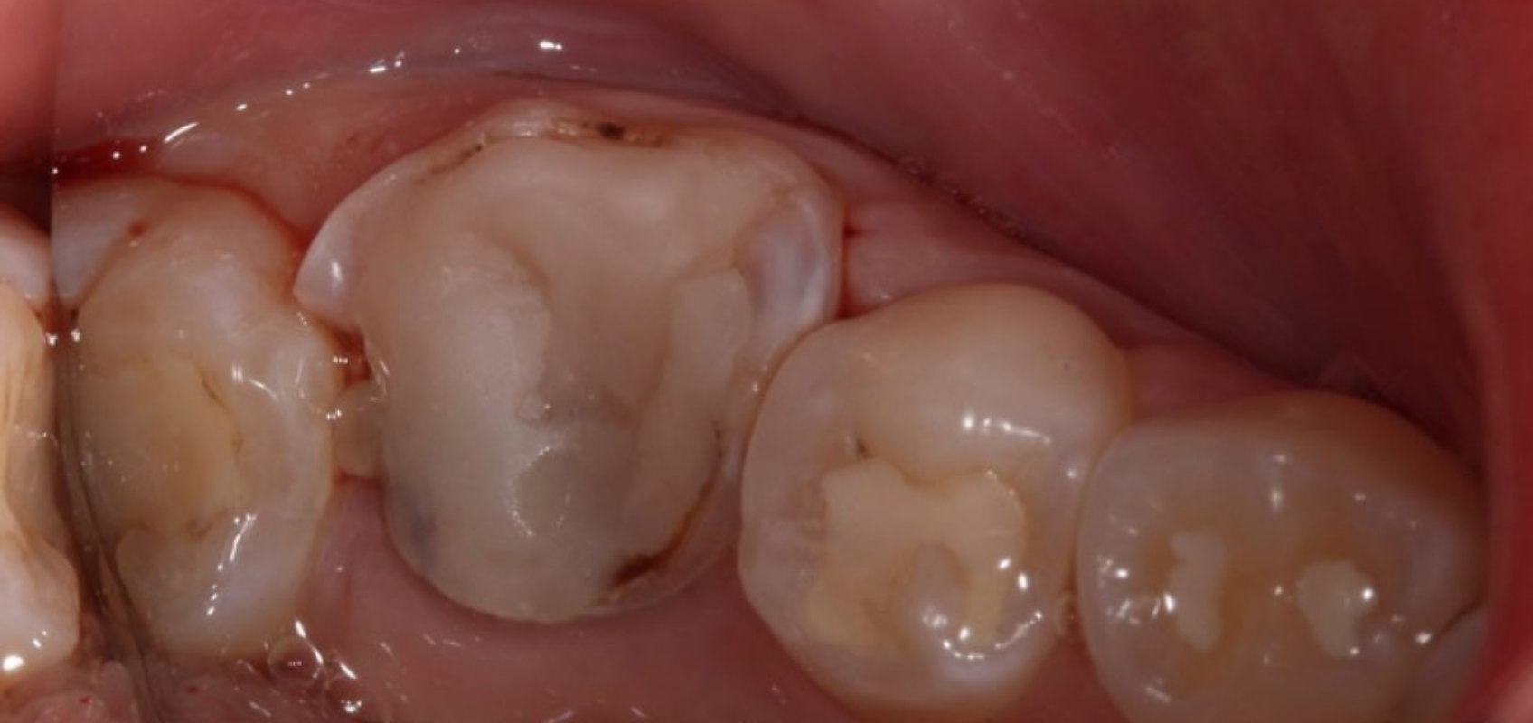 efrver Preoperative view of a deep carious lesion on tooth #19 before direct pulp capping, showing extensive decay near the dental pulp.