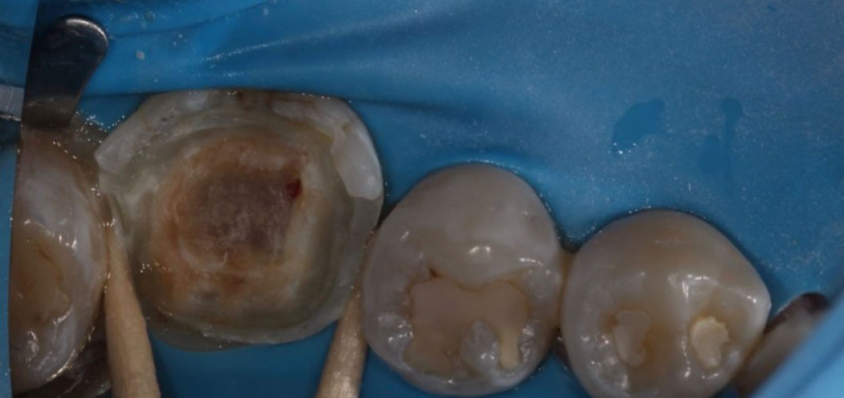 efrver Clinical view during direct pulp capping showing a small pulp exposure on tooth #19 after caries excavation with hemostasis achieved.