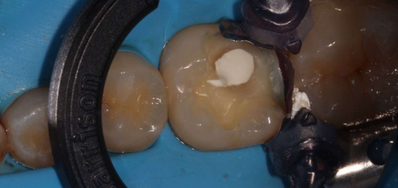 efrver Placement of bioceramic material during an indirect pulp capping procedure to protect the pulp and promote healing.