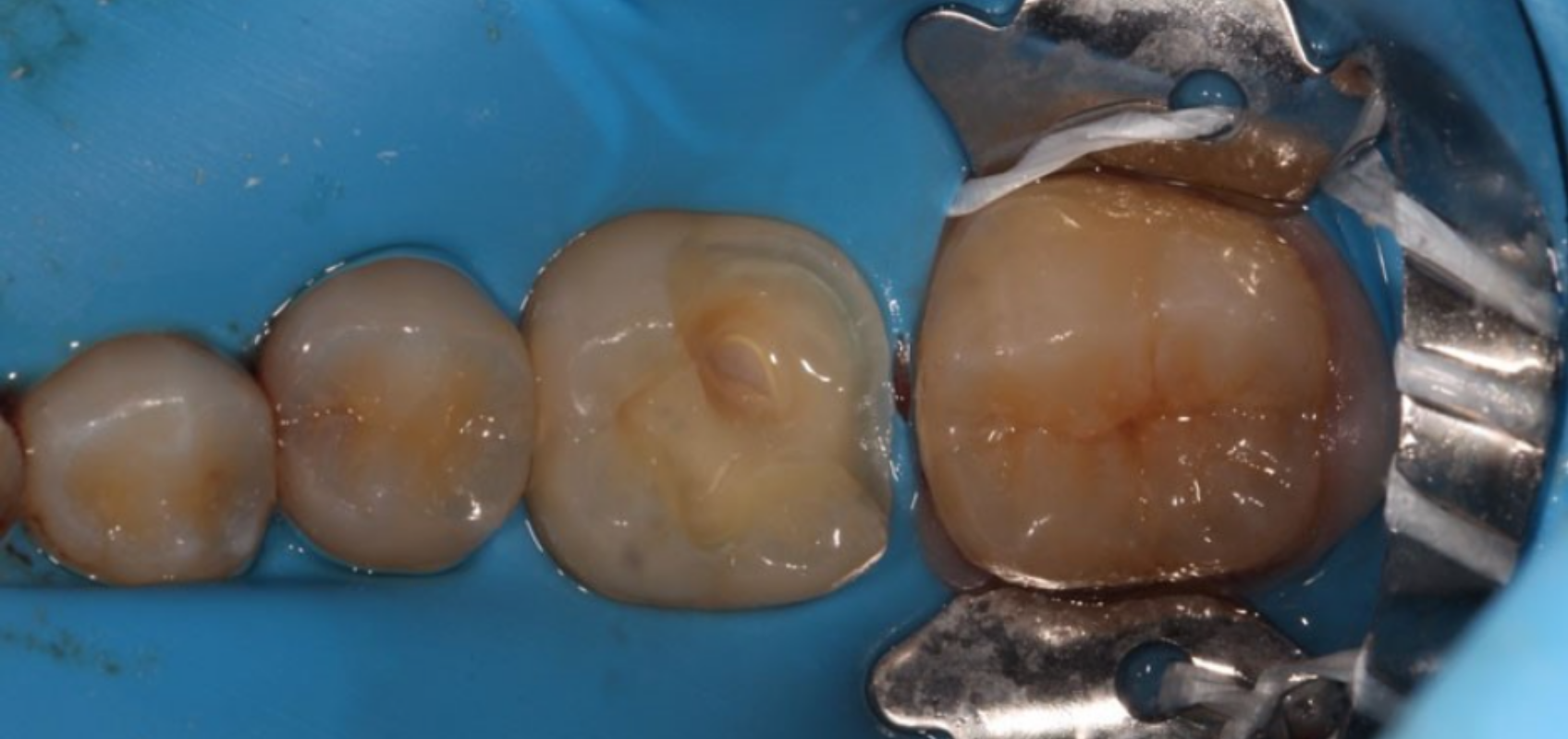 efrver Caries excavation during indirect pulp capping showing pulpal blushing at the deepest aspect of the preparation.
