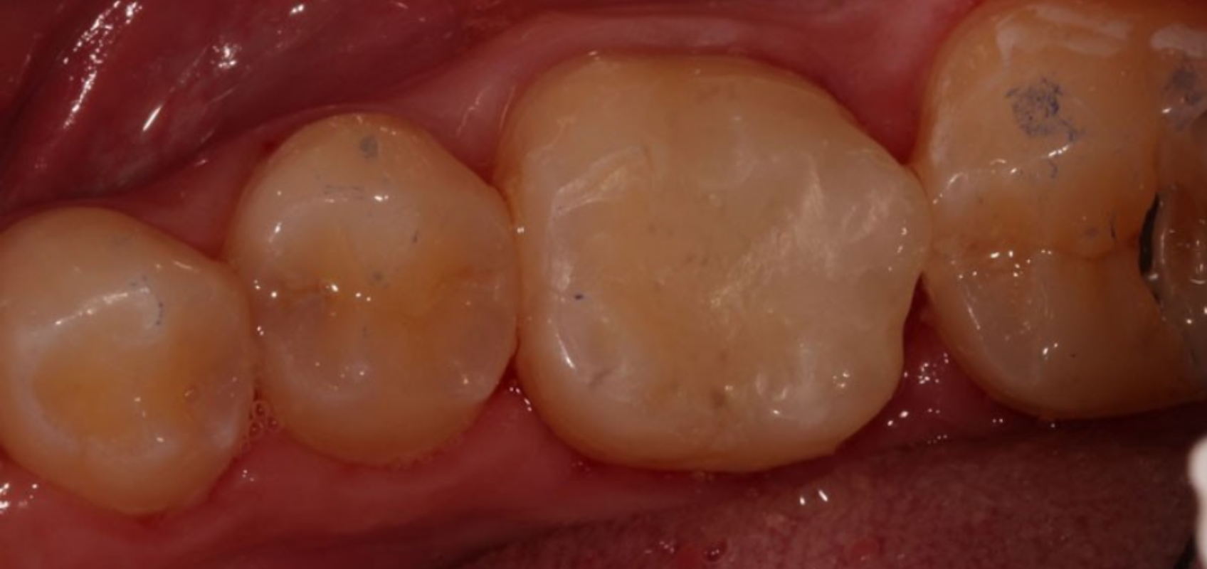 efrver Completed composite restoration following a single-visit indirect pulp capping procedure.