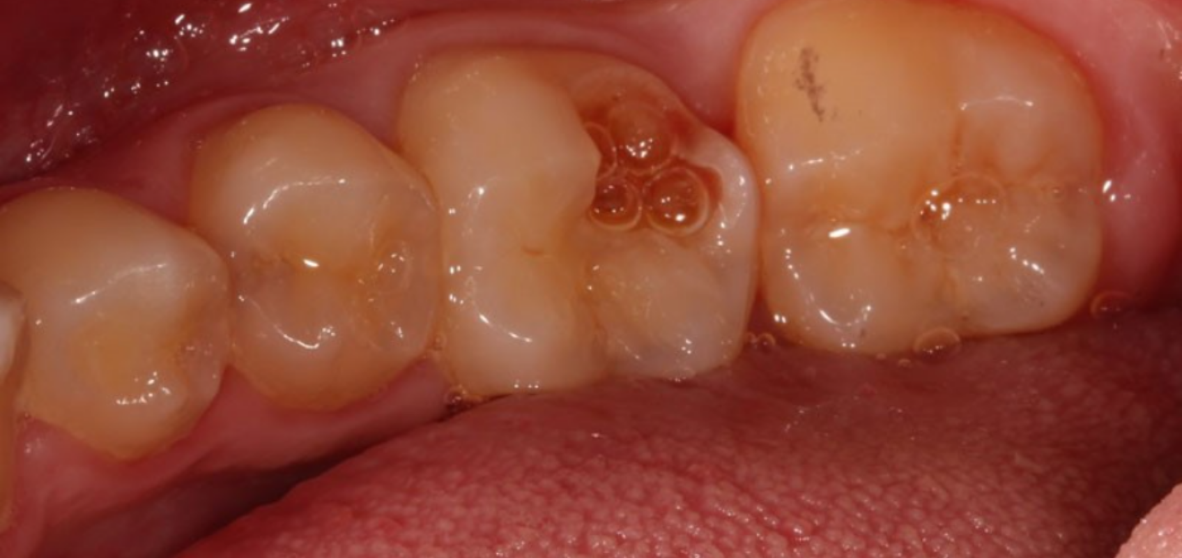 efrver Preoperative view of a deep carious lesion approaching the pulp chamber before indirect pulp capping treatment.