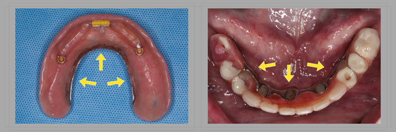 Using the Matrix Technique for Repairing Debonded Denture Teeth Dichter using matrix repairing debonded teeth 02 1