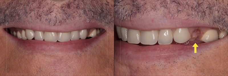 Using the Matrix Technique for Repairing Debonded Denture Teeth Dichter using matrix repairing debonded teeth 03 1