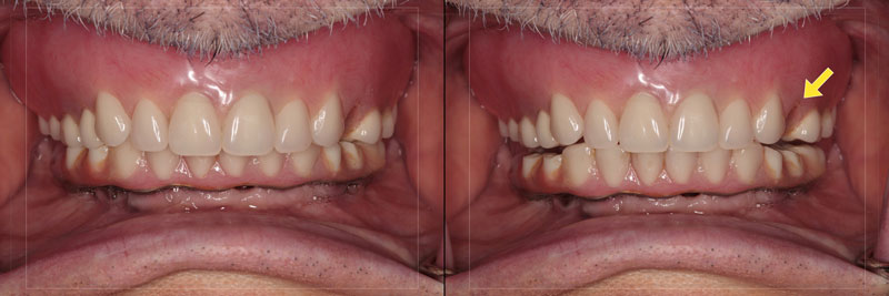 Using the Matrix Technique for Repairing Debonded Denture Teeth Dichter using matrix repairing debonded teeth 04 1