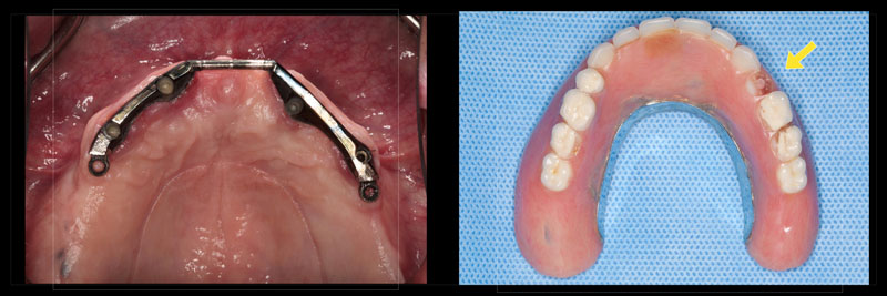 Using the Matrix Technique for Repairing Debonded Denture Teeth Dichter using matrix repairing debonded teeth 05 1