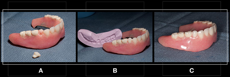 Using the Matrix Technique for Repairing Debonded Denture Teeth Dichter using matrix repairing debonded teeth 07 1