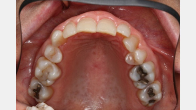 Red Flag-Maxillary First Premolar Extraction for Orthodontics