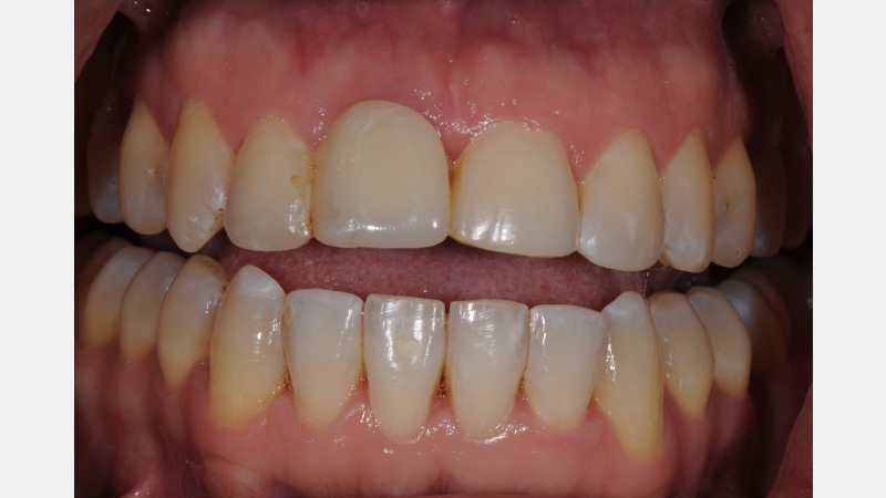 A Guide to Pre-Prep Diagnostic Mock-Ups Bonk guide pre prep diagnostic mock ups 02 2