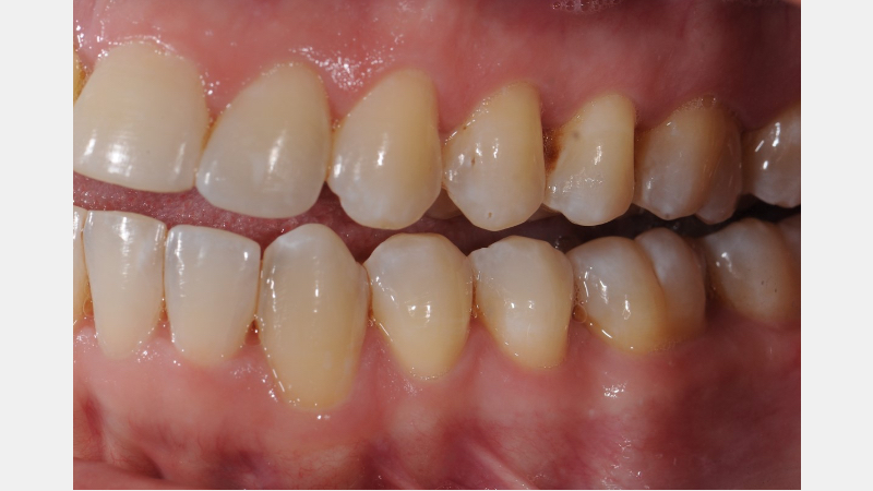 A Guide to Pre-Prep Diagnostic Mock-Ups Bonk guide pre prep diagnostic mock ups 03 2